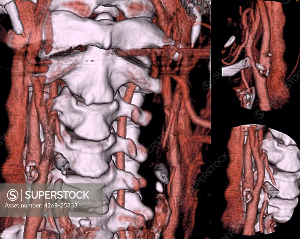 Stenosis. 3D computed tomographic (CT) scan reconstruction of a stenosis of the left internal carotid artery, visible at left of the 3rd cervical vertebra.