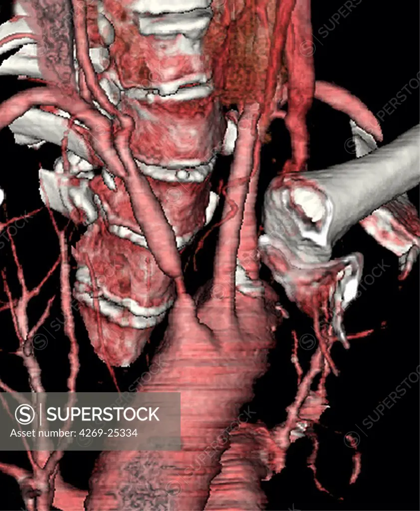 Stenosis. 3D computed tomographic (CT) scan reconstruction of a stenosis of the brachiocephalic trunk. The narrowed section of the artery is visible just above the aortic arch.