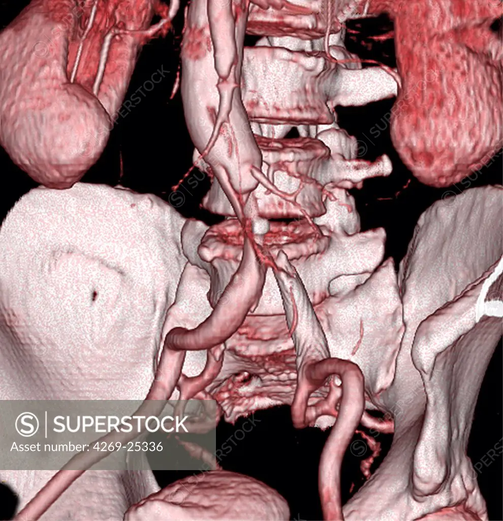 Stenosis. 3D computed tomographic (CT) scan reconstruction of a stenosis of the abdominal aorta. The stenosed part is clearly seen just before the bifurcation of the iliac arteries.