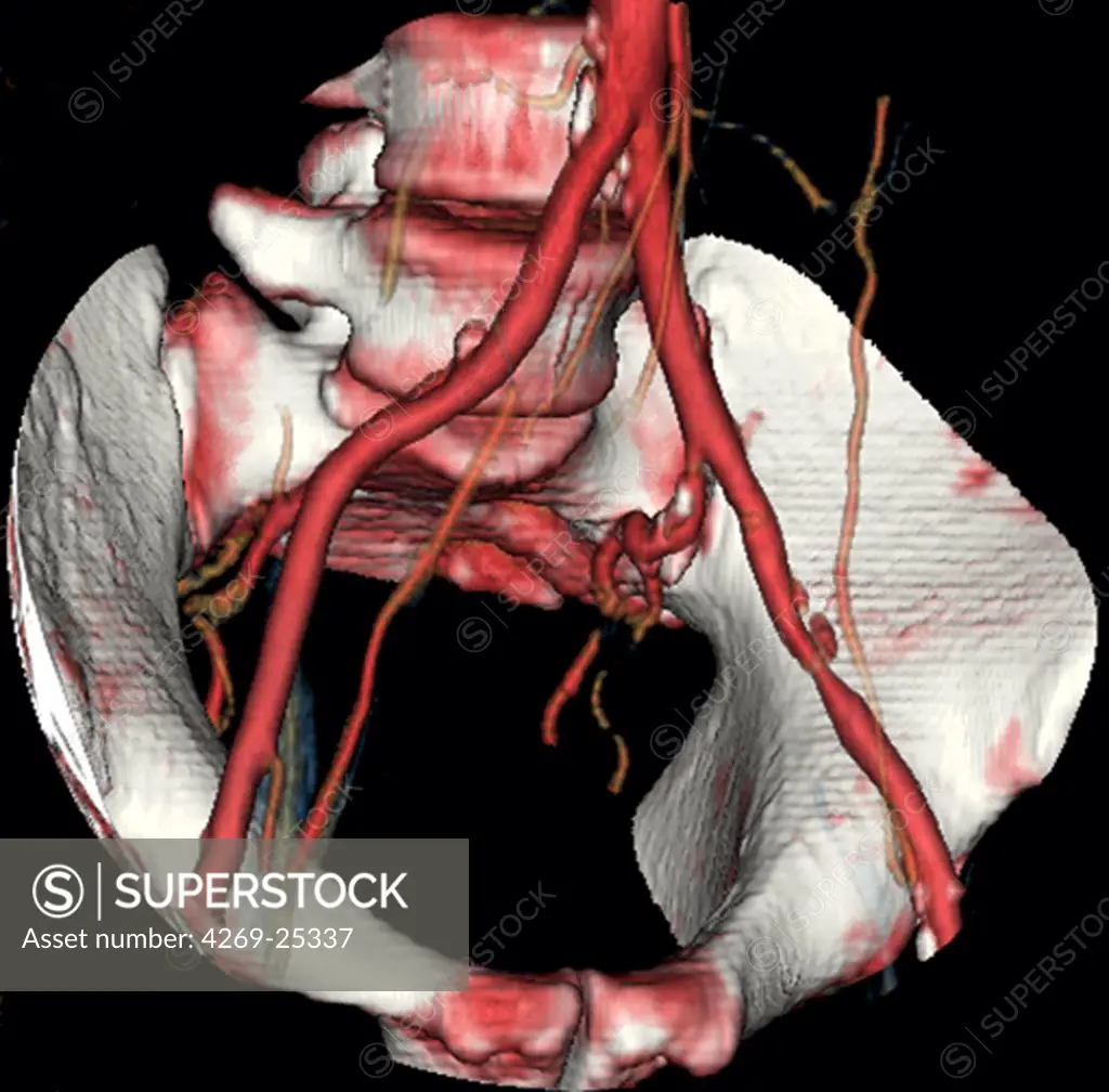 Stenosis. 3D computed tomographic (CT) scan reconstruction of a stenosis of the right external iliac artery.