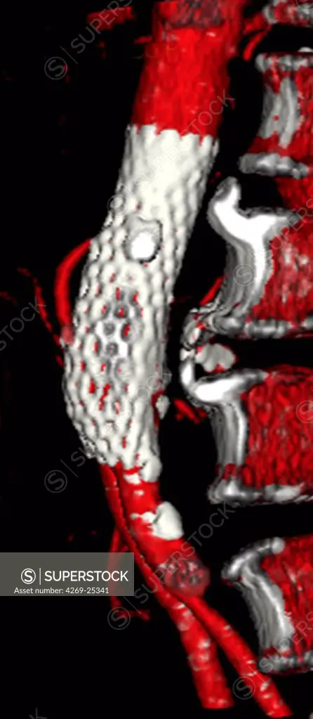Stent prosthesis. 3D computed tomographic (CT) scan reconstruction (side view) of a stenosis of the aorta (in red) treated with a stent prosthesis (white).