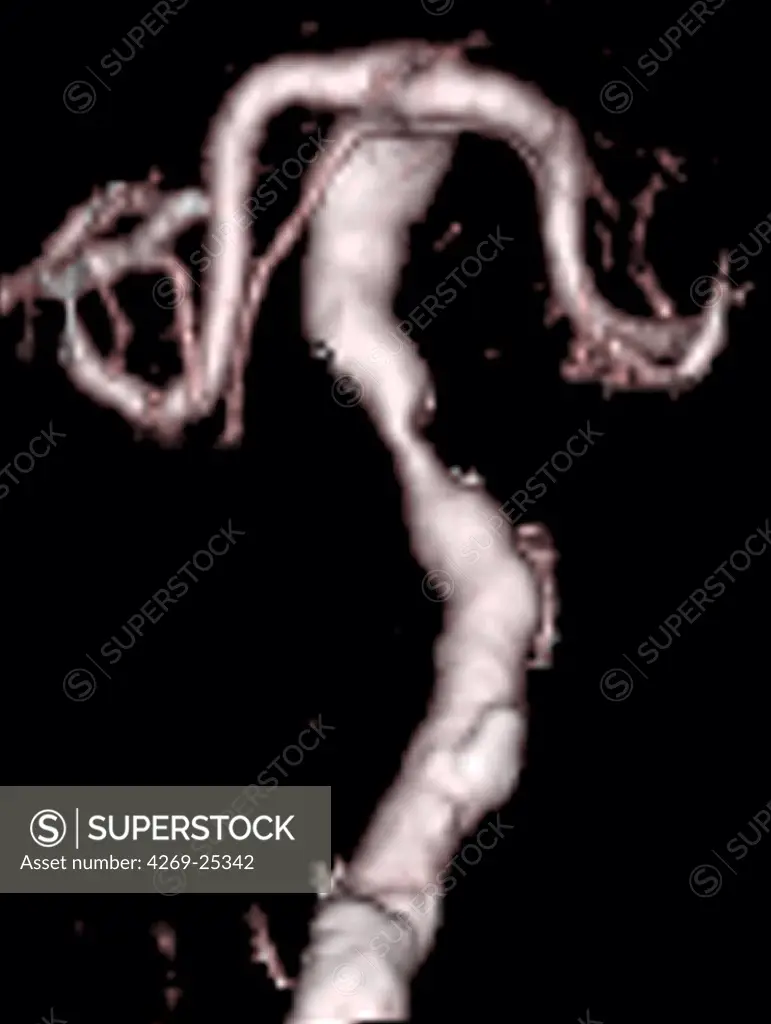 Stenosis. 3D computed tomographic (CT) scan reconstruction (face view) of a stenosis of the basilar artery.