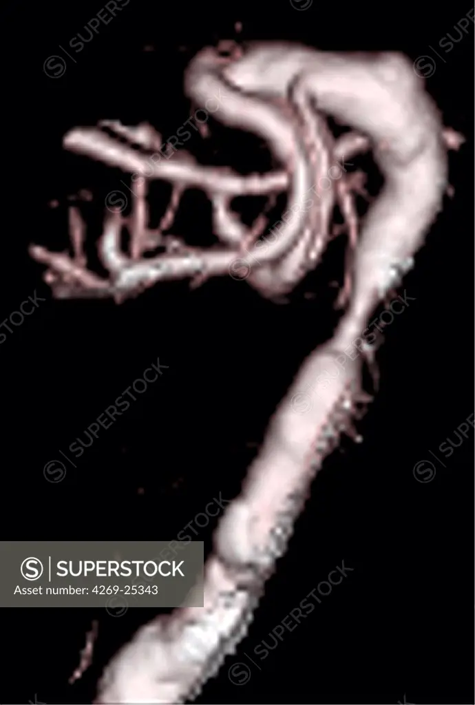 Stenosis. 3D computed tomographic (CT) scan reconstruction (side view) of a stenosis of the basilar artery.