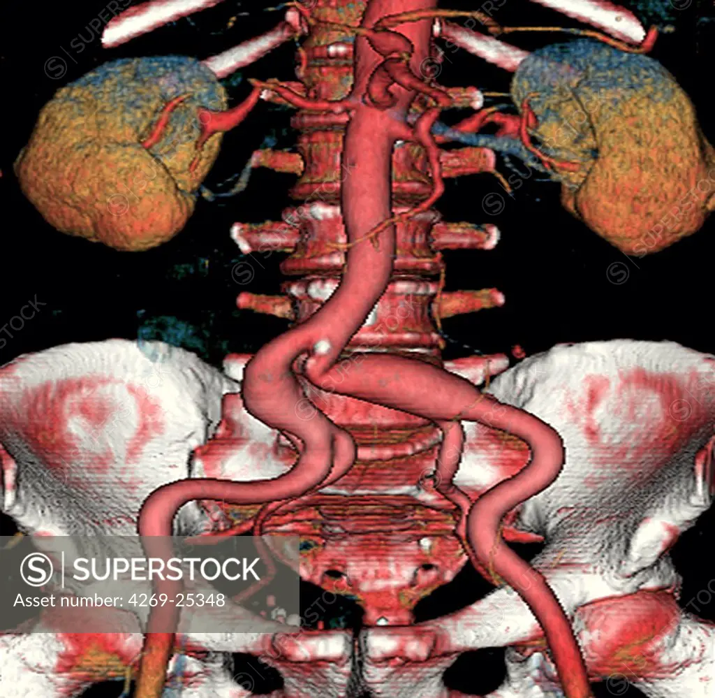 Bi-iliac aneurysm. Three-dimensional computed tomographic (CT) scan reconstruction of bi-iliac aneurysm. The aneurysms appear as a swollen bulge located on the beginning of the common iliac arteries that irrigate the lower limbs. An aneurysm is a bulge of a vessel due to the dilatation of its wall. A ruptured aneurysm can be fatal.