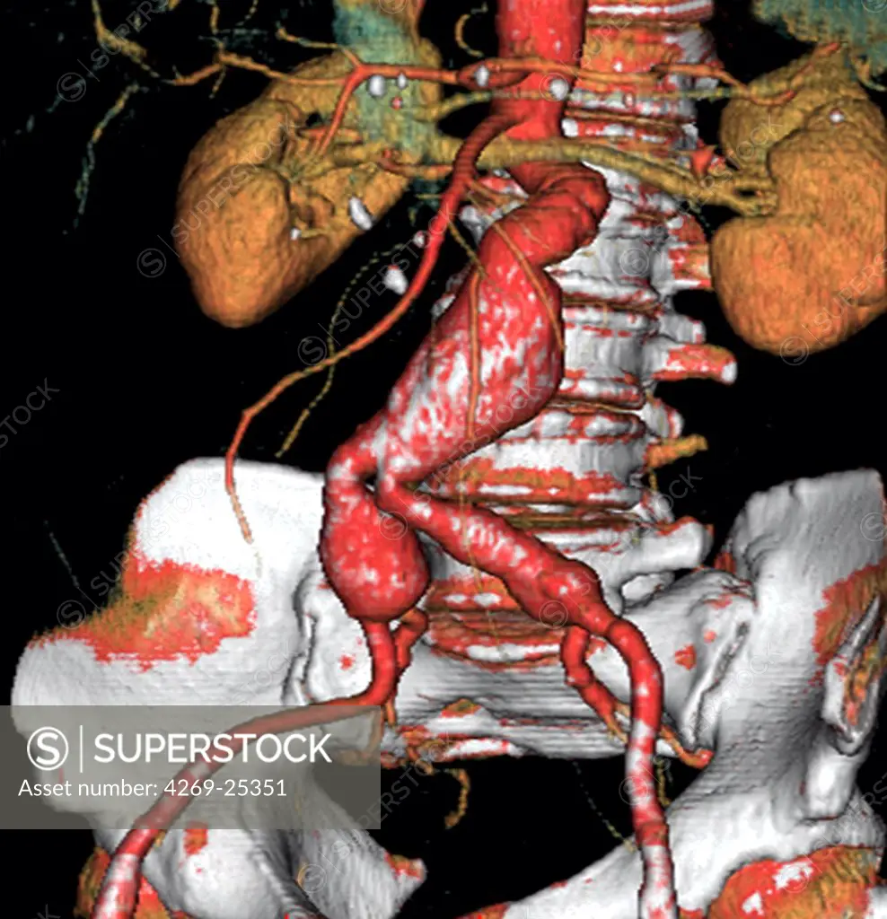 Abdominal aorta aneurysm. hree-dimensional computed tomographic (CT) scan reconstruction of an abdominal aorta aneurysm. It appears as swollen bulge  located under the renal arteries and extending until the two comon iliac arteries. An aneurysm is a bulge of a vessel due to the dilatation of its wall. A ruptured aneurysm can be fatal.