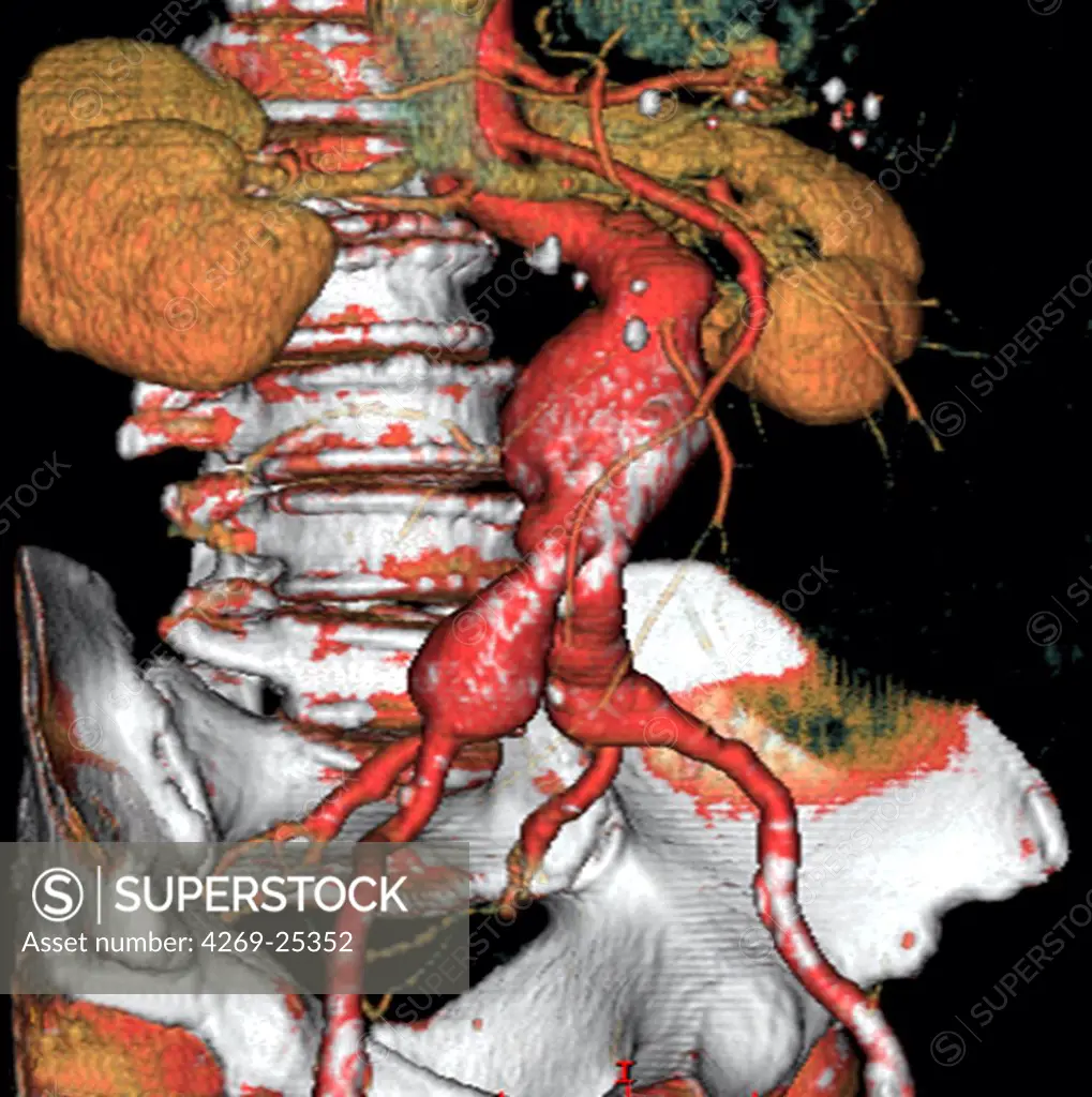Abdominal aorta aneurysm. hree-dimensional computed tomographic (CT) scan reconstruction of an abdominal aorta aneurysm. It appears as swollen bulge  located under the renal arteries and extending until the two comon iliac arteries. An aneurysm is a bulge of a vessel due to the dilatation of its wall. A ruptured aneurysm can be fatal.