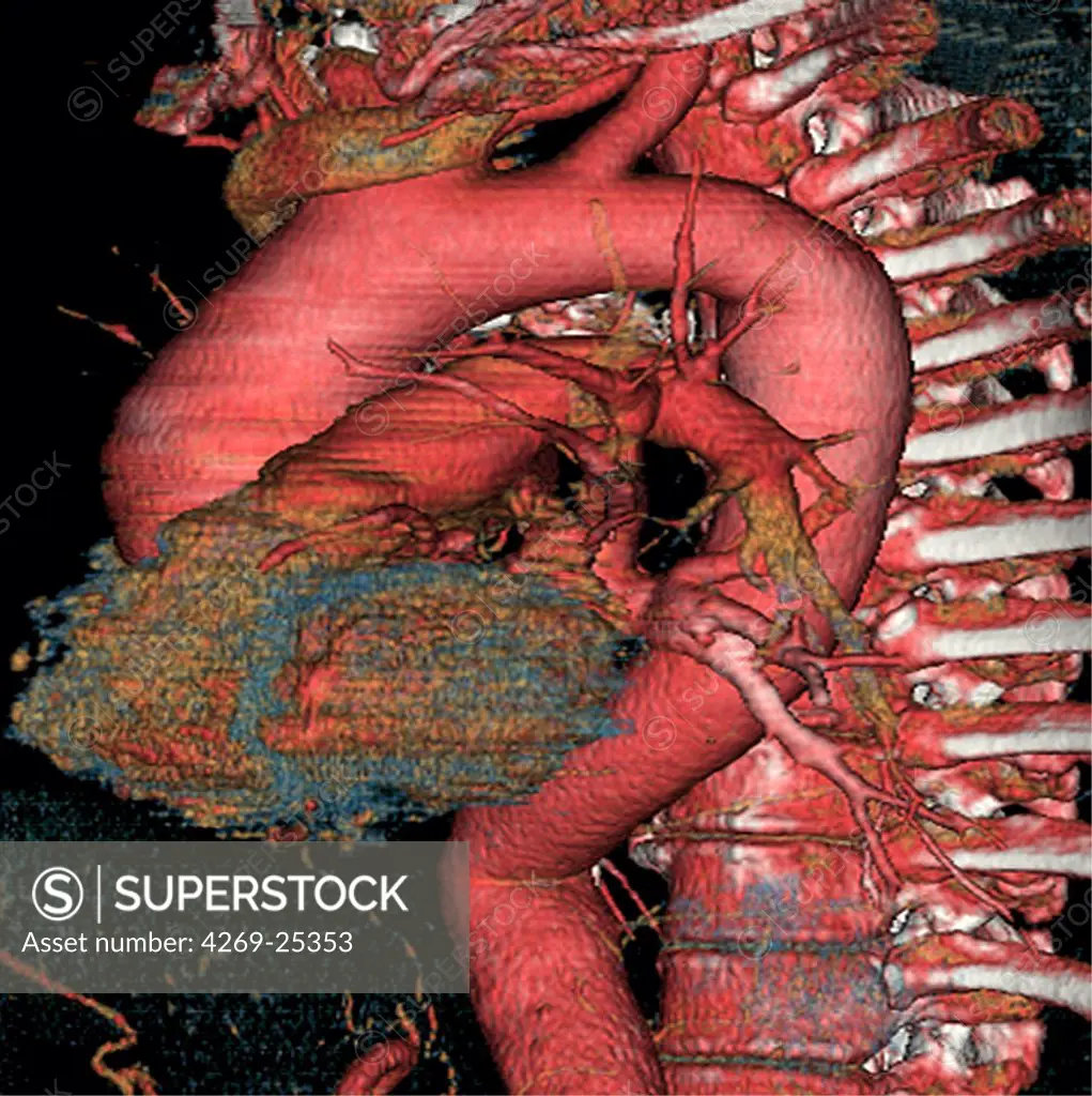 Ascending aortic aneurysm. 3D computed tomographic (CT) scan reconstruction of aortic aneurysm. The aneurysm appears as a swollen bulge located on the ascending aorta, between the aortic arch and the heart (a part of it visible in ocre blue). An aneurysm is a bulge of a vessel due to the dilatation of its wall. A ruptured aneurysm can be fatal.