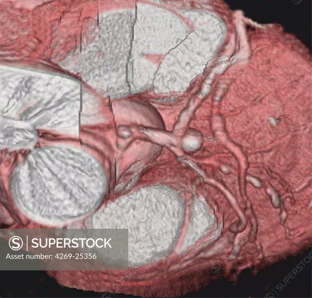 Left coronary artery aneurysm. 3D computed tomographic (CT) scan reconstruction of left coronary artery aneurysm. The aneurysm appears as a swollen bulge in the center of the image. The coronary arteries feed the cardiac muscle in oxygen. An aneurysm is a bulge of a vessel due to the dilatation of its wall. A ruptured aneurysm can be fatal.