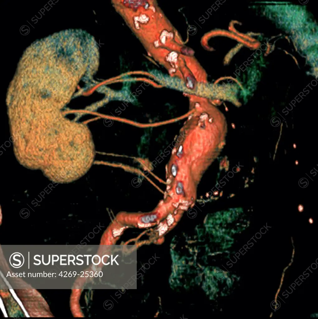 Sub-renal abdominal aorta aneurysm. 3D computed tomographic (CT) scan reconstruction of sub-renal abdominal aorta aneurysm. It appears as swollen bulge  located under the renal arteries and before its division in the two comon iliac arteries. The left kidney is visible hereAn aneurysm is a bulge of a vessel due to the dilatation of its wall. A ruptured aneurysm can be fatal.