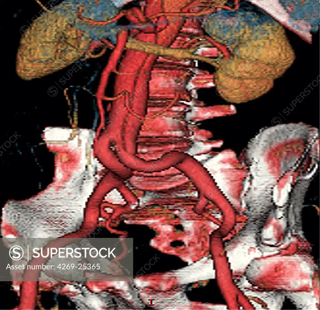 Dissecting aneurism of abdominal aorta. 3D computed tomographic CT) scan reconstruction of a dissecting  aneurism of the sub-renal abdominal aorta. In this type of aneurysm, the inner wall of the aorta (intima) detaches from the outter wall (media). The blood invades the created space and generate a bulge that can break. The aneurysm is visible as a longitudinal  furrow that extends from the renal arteries to the common iliac arteries.