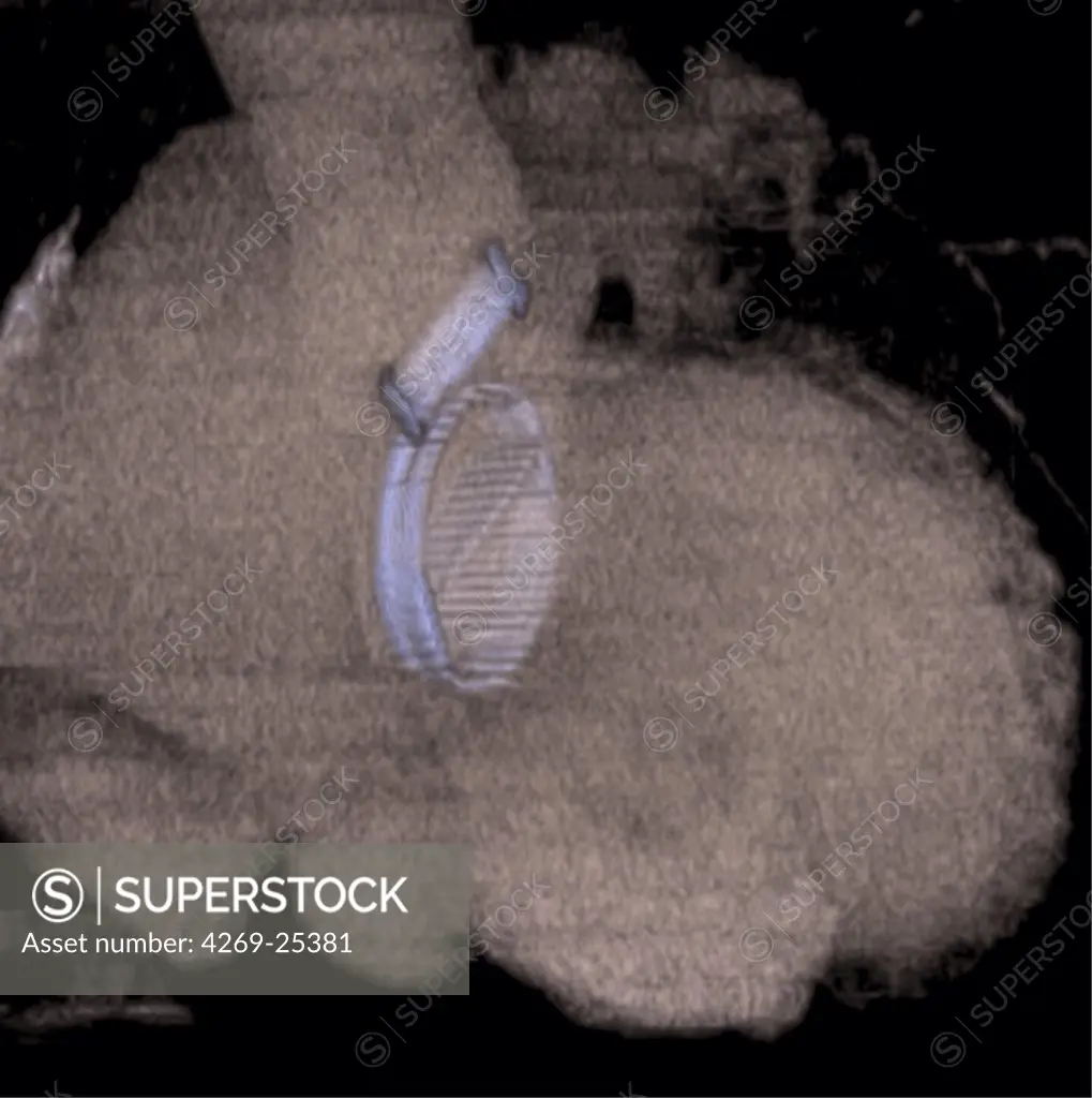 Prosthetic cardiac valves. 3D computed tomographic (CT) scan reconstruction of prosthetic mitral valve below (situated between the left atrium and the left ventricle), and an prosthetic aortic valve above (between the left ventricle and the aorta).