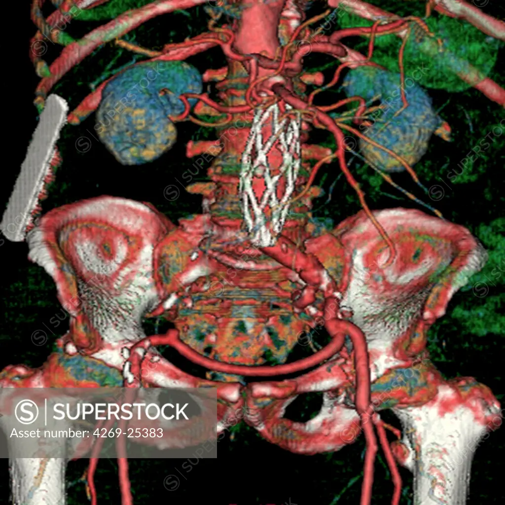 Stent prosthesis on the aorta. Three-dimensional computed tomographic (CT) scan reconstruction of abdominal aortic aneurysm treated with a Stent. An aneurysm is a bulge of a vessel due to the dilatation of its wall. A ruptured aneurysm can be fatal. The treatment includes strenghtening the damaged part of the artery thanks to the reticulated cylindrical structure of a stent (white) introduced during angioplasty.