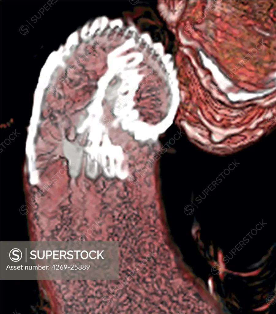 Imroperly placed Stent prosthesis. 3D computed tomographic (CT) scan reconstruction showing a stent prosthesis that 'collapsed' on itself when inserted in the vessel.