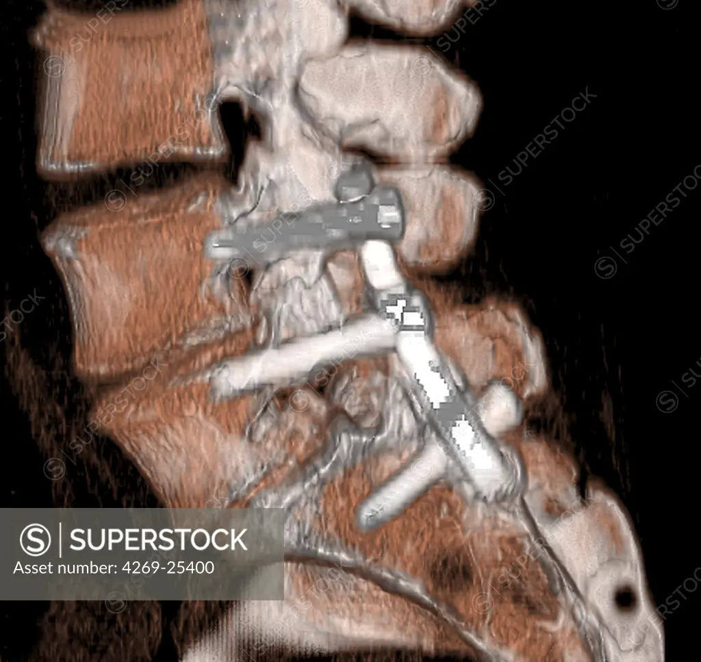 Osteosynthesis. 3D computed tomographic (CT) scan reconstruction (side view) of the lower backbone showing the sacrum and last lumbar vertebras (L4 and L5) maintained by pins further to a fracture.