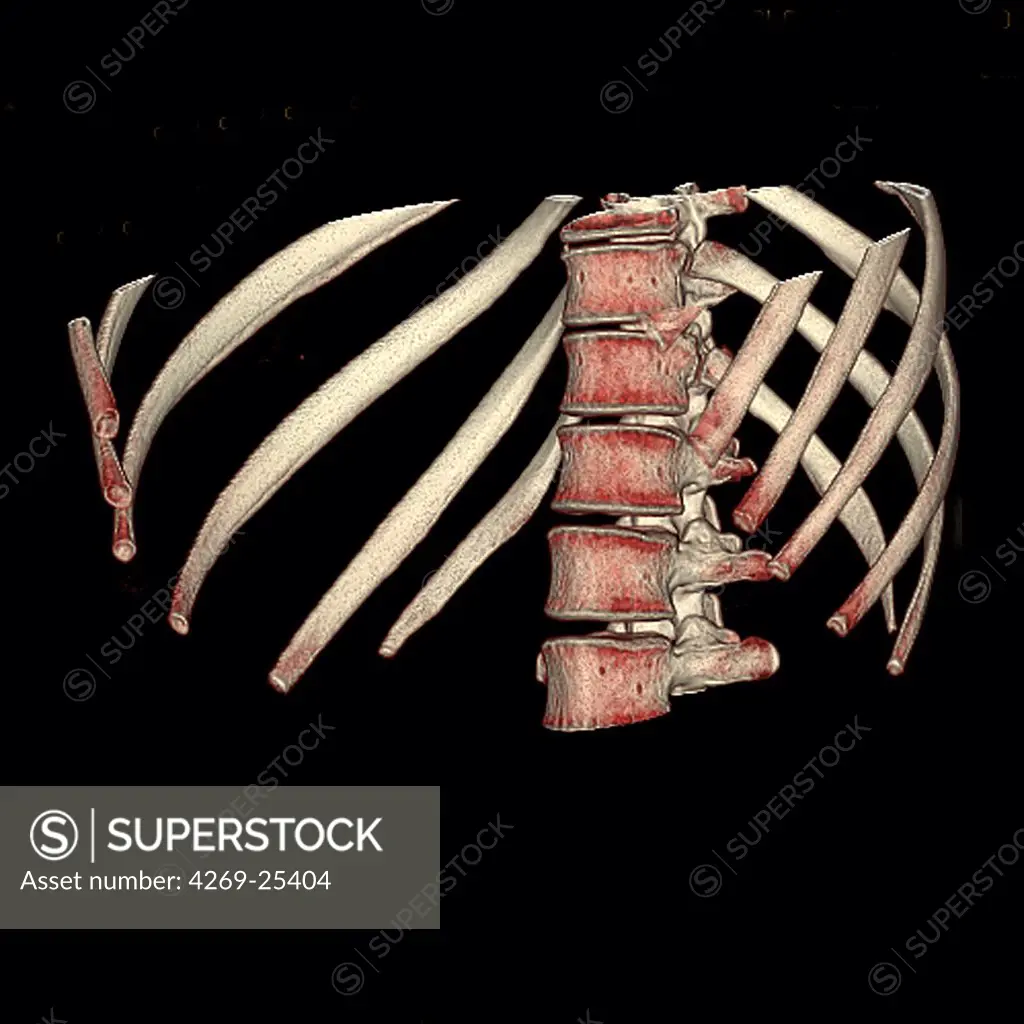 Ribs and vertebras. 3D computed tomographic (CT) scan reconstruction showing the middle part of the backbone and the lower ribs.