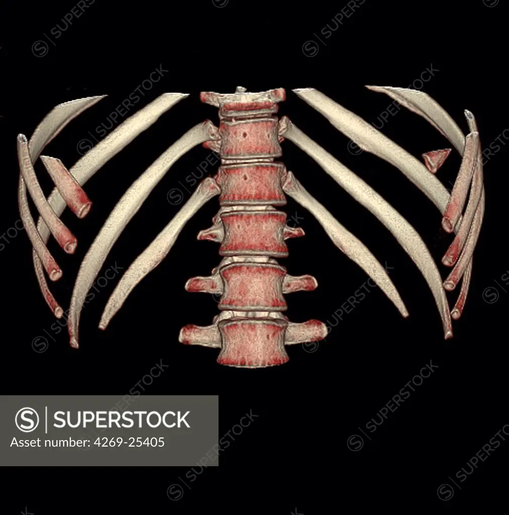 Ribs and vertebras. 3D computed tomographic (CT) scan reconstruction showing the middle part of the backbone and the lower ribs (face view).