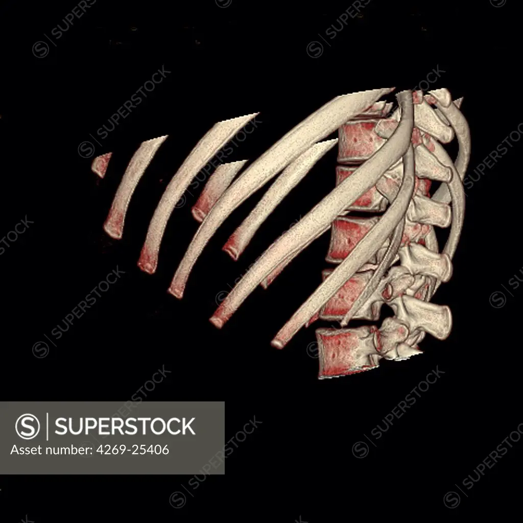 Ribs and vertebras. 3D computed tomographic (CT) scan reconstruction showing the middle part of the backbone and the lower ribs (side view).