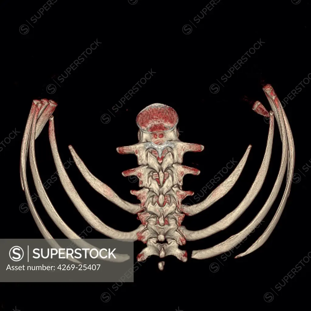 Ribs and vertebras. 3D computed tomographic (CT) scan reconstruction showing the middle part of the backbone and the lower ribs seen from behind.
