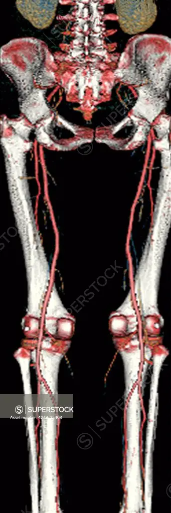Bassin and legs arteries. 3D computed tomographic (CT) scan reconstruction of the lower part of the body showing the bones of the legs and coccyx, and its blood system. In the groin, the iliac arteries split off to supply blood to internal tissues and organs. The arteries between each split are named for the region of the leg: iliac (groin), femoral (thigh), popliteal (knee) and tibial (calf).