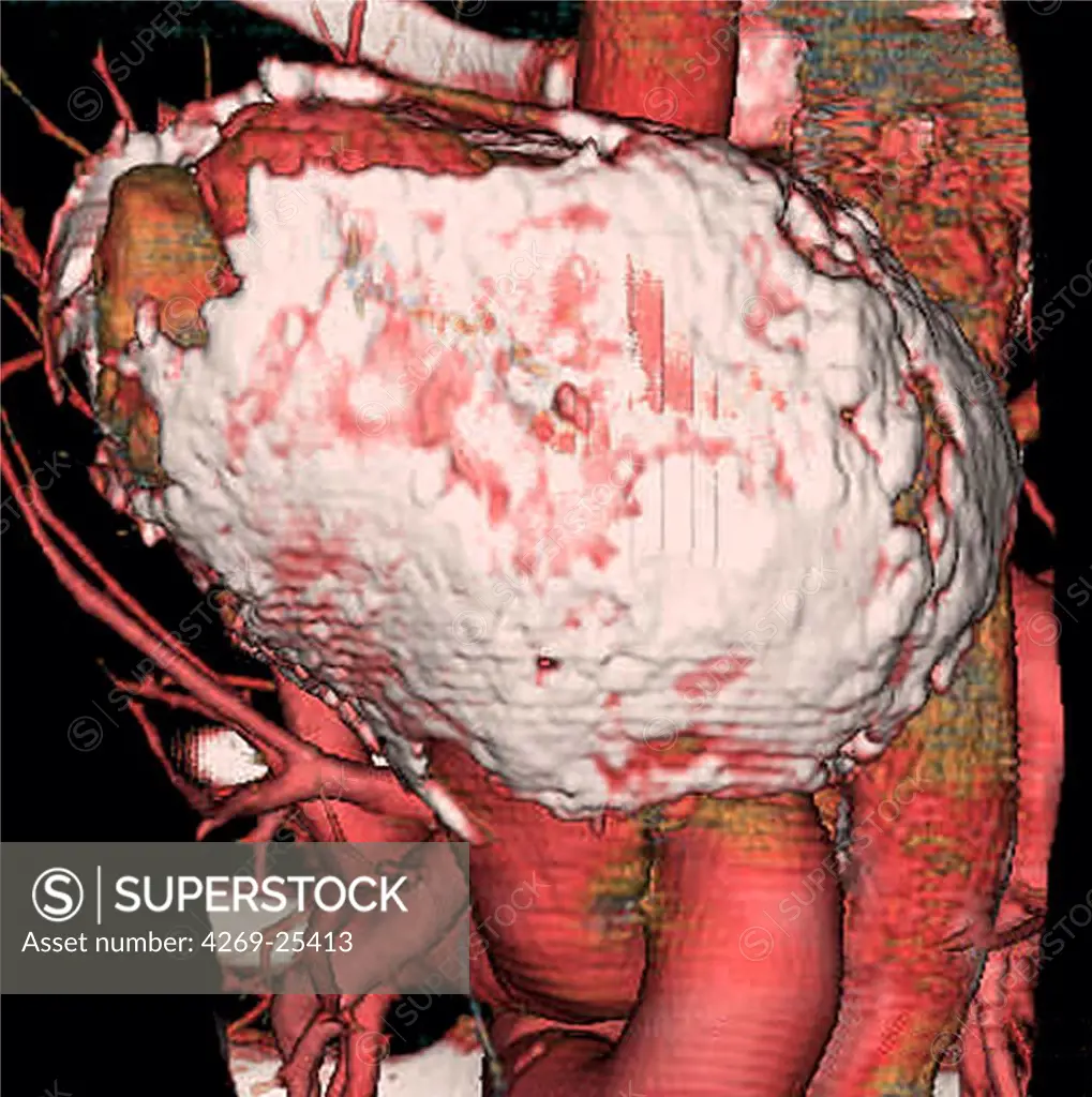 Calcifying pericarditis. 3D computed tomographic (CT) scan reconstruction of a heart affected by calcifying pericarditis (armoured heart) seen from above. Pericarditis is the inflammation of the pericardium, a thin layer of tissue that covers the outer surfaces of the heart. Here, the pericardium is covered by a fibrous calcarious rigid bag (white coat) and can not complete its natural mouvements.
