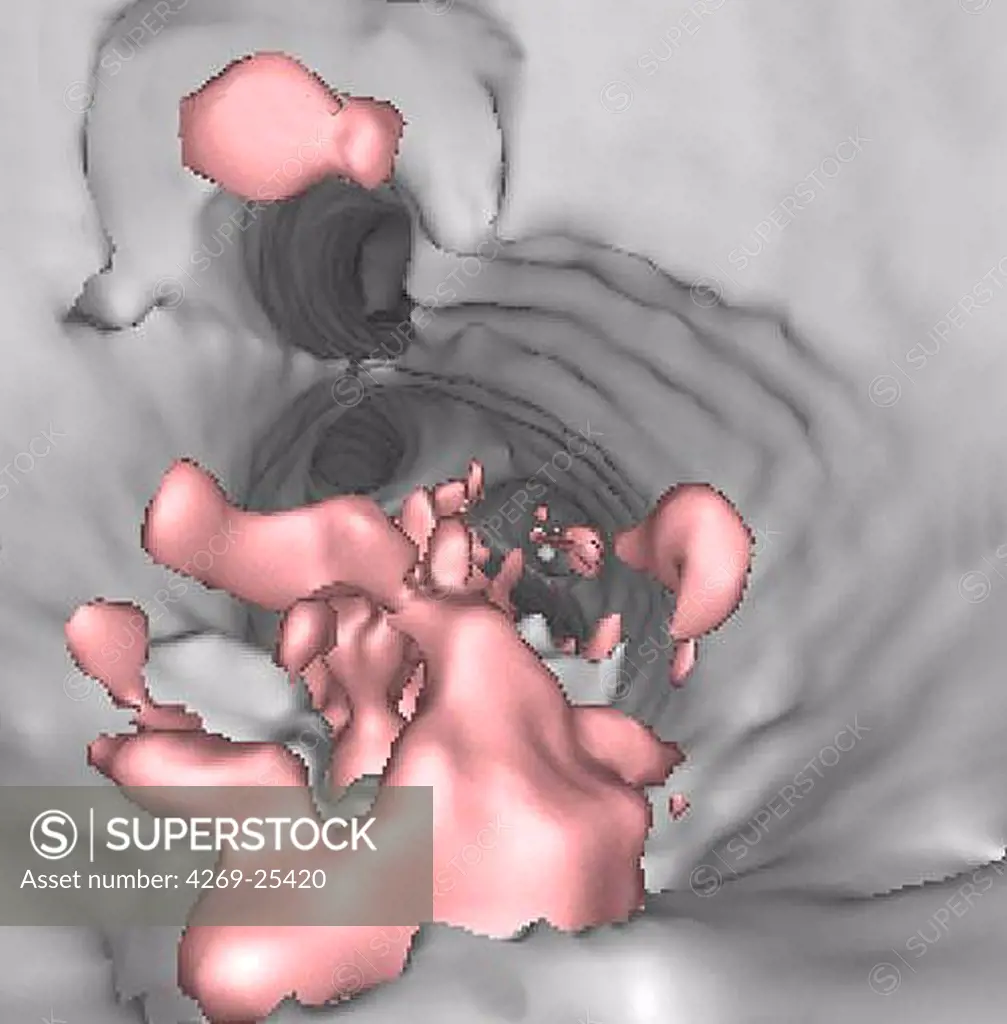 Atherosclerosis. 3D computed tomographic (CT) scan (virtual endoscopy) showing atheromatous plaques (in pink) inside an artery. This fatty deposit narrows the vessel and restricts the blood flow (atherosclerosis).