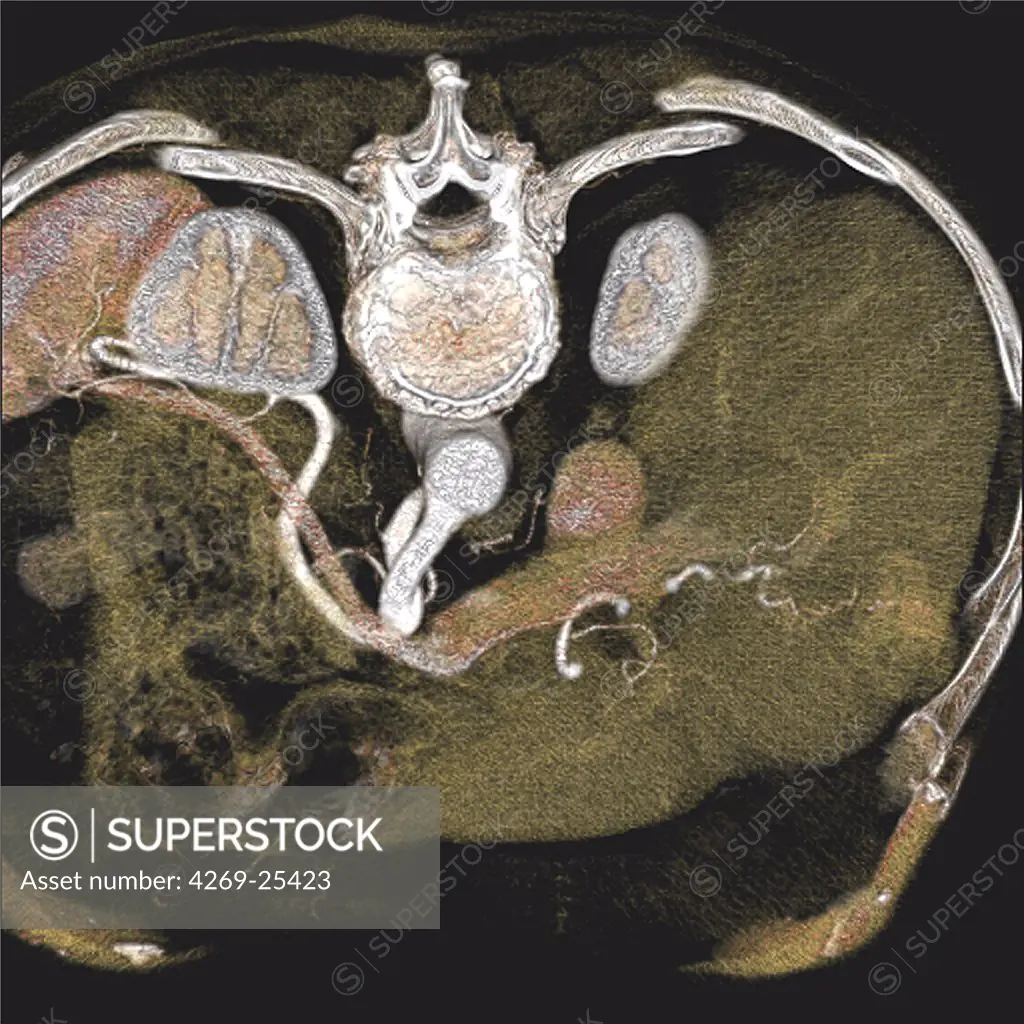 Liver cancer. Three-dimentional tomographical (CT) scan reconstruction of a liver tumor. The back of the patient is at top. The vertebraes of the backbone and the ribs are in white. The tumor appear as a white ovale spot the right lobe, at right on the photo.