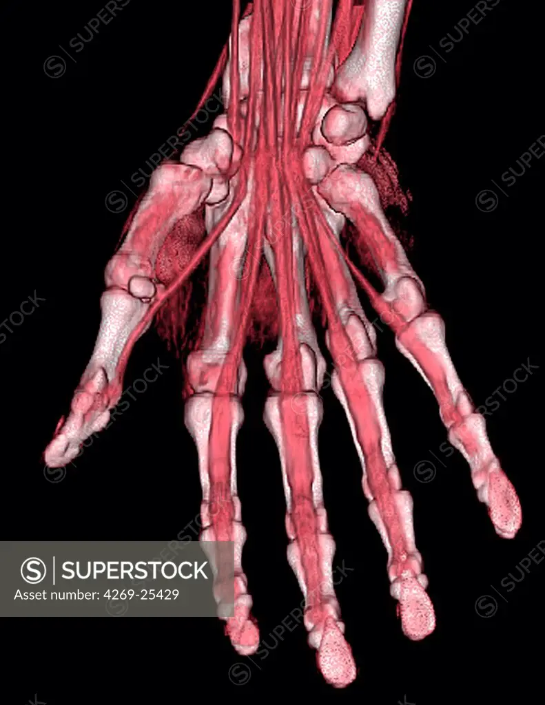 Hand. 3D computed tomographic (CT) scan reconstruction of the left hand showing the bones and tendons.