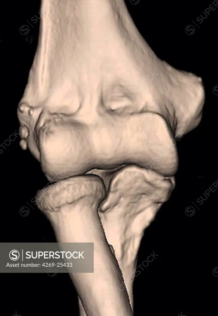 Epicondylitis. 3D computed tomographic (CT) scan reconstruction of the elbow showing the head of the humerus (top), and the tips of the radius and ulna (below), the bones of the forearm. The inflammation of the epicondyle and surrounding tendons further to muscle overwork is called epicondylitis, or tennis elbow.