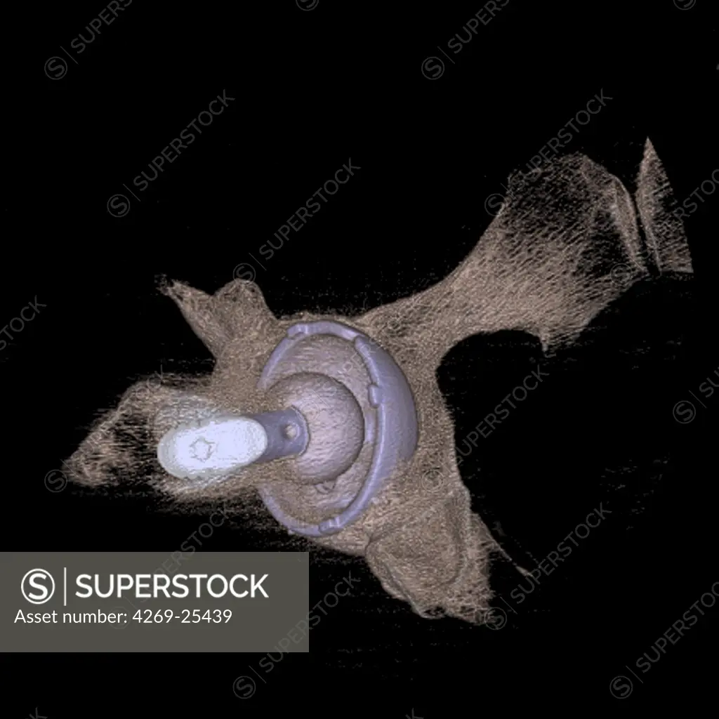 Prosthetic hip. 3D computed tomographic (CT) scan reconstruction of a ball-and-socket prosthetic joint used to replace the old hip joint. The upper 'ball' end swivels in the artificial cavity surgically implanted into the pelvis (seen here). The other end extends down into a hole drilled into the femur (thigh bone) (not seen).