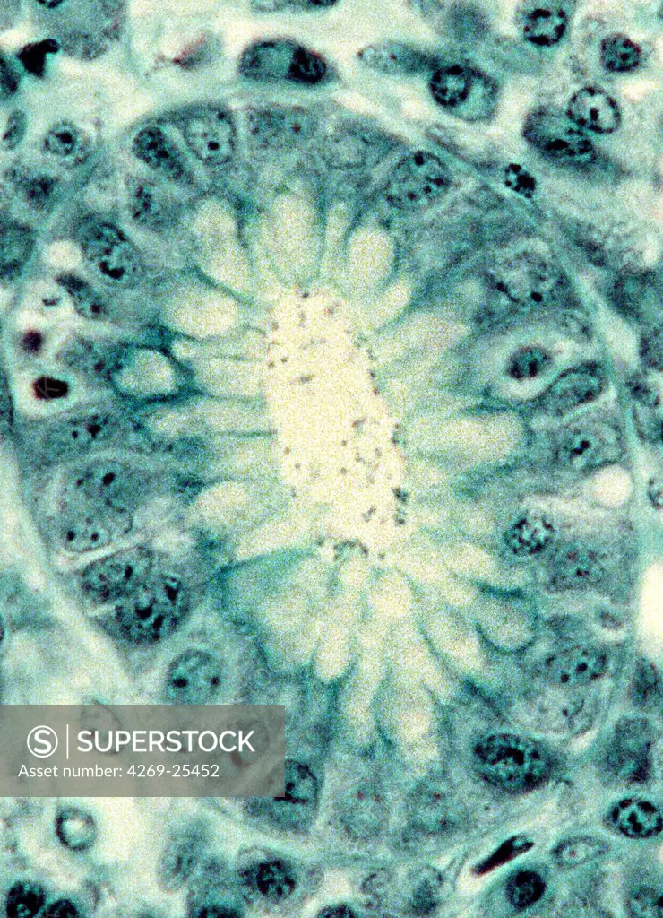 Histology. Infection of stomach lining by Helicobacter pylori bacteria causing interstitial gastritis. Light microscopy