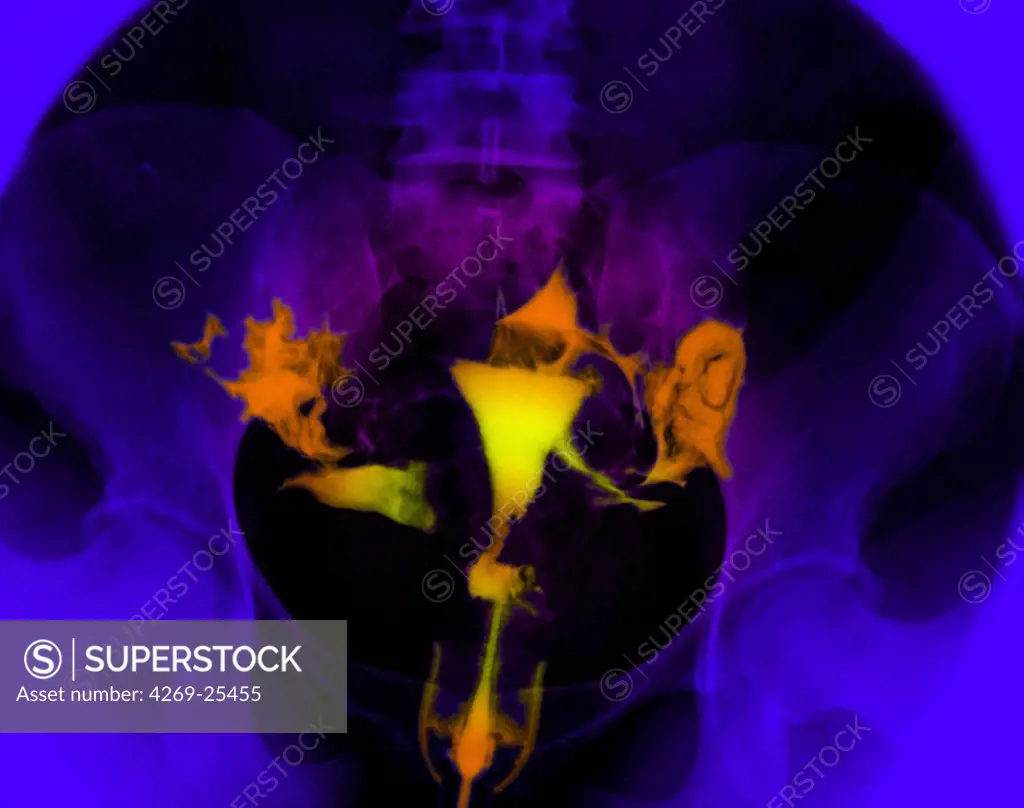 Hysterography. X-ray of female reproductive organs. A contrast medium was introduced into the uterus (center) and its Fallopian tubes (oviducts, thin, extending from uterus) through the uterine neck.