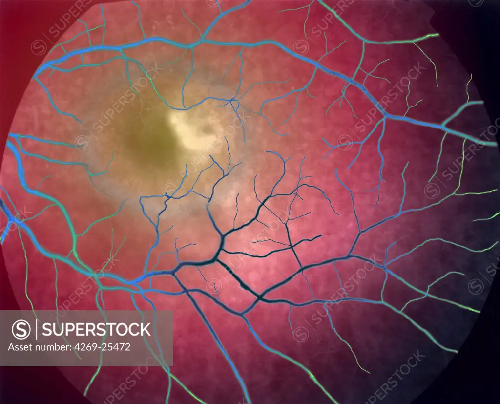 ARMD. Eye angiography of an Age-Related Macular Degeneration (ARMD).