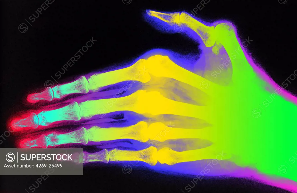 Rheumatoid polyarthritis. X-ray of hand with Rheumatoid polyarthritis. Rheumatoid arthritis is a chronic joint disease that can cause cartilage destruction, bone erosions, and tendon inflammation and rupture. It can lead to polyarthritis which happens when inflammation spread to multiple joints by.