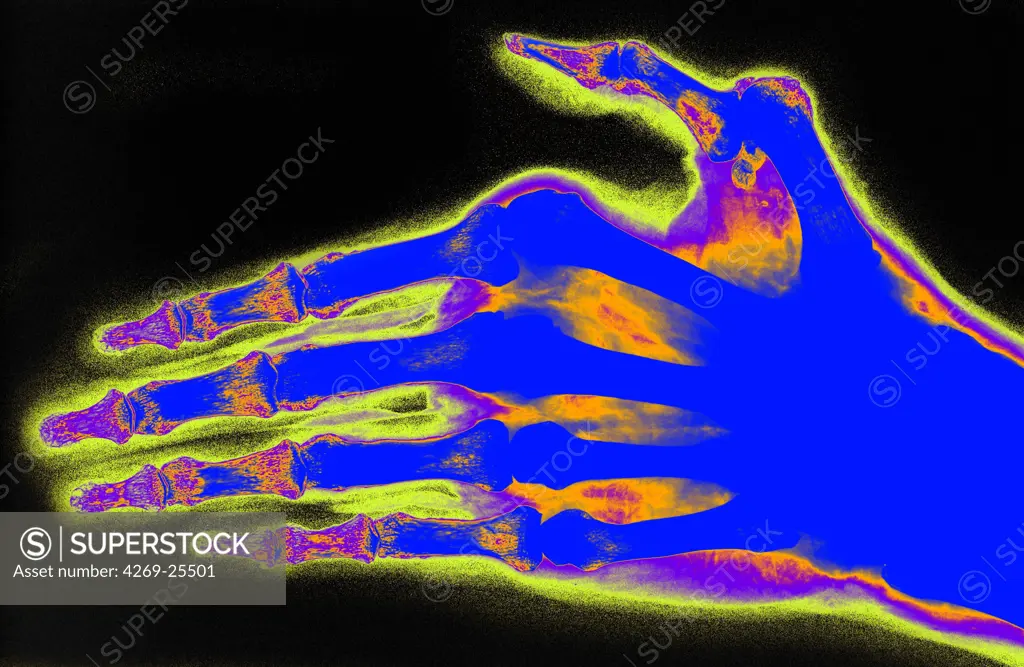 Rheumatoid polyarthritis. X-ray of hand with Rheumatoid polyarthritis. Rheumatoid arthritis is a chronic joint disease that can cause cartilage destruction, bone erosions, and tendon inflammation and rupture. It can lead to polyarthritis which happens when inflammation spread to multiple joints by.