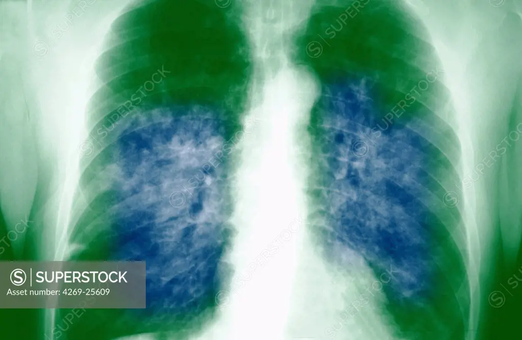 SARS. Chest x-ray showing Severe Acute Respiratory Syndrome (SARS), a viral respiratory illness. SARS is caused by a coronavirus and can lead to pneumonia. Very contagious, it spreads by close person-to-person contact.