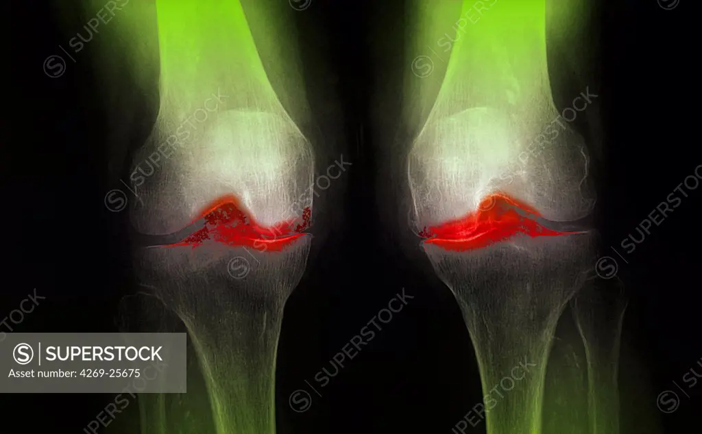 Knee arthrosis. X-ray of knees affected by arthosis (green), also called osteoarthritis or gonarthrosis. It is a joint disease that can cause cartilage destruction (seen as a reduction in the joint space), bone erosions, and tendon inflammation.