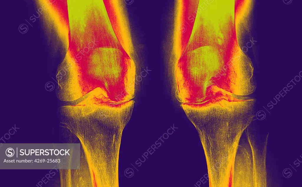 Knee arthrosis. X-ray of knees affected by arthosis (green), also called osteoarthritis or gonarthrosis. It is a joint disease that can cause cartilage destruction (seen as a reduction in the joint space), bone erosions, and tendon inflammation.