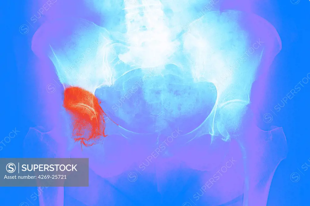 Hip osteoarthritis. X-ray showing arthritis of the hip. At lower left and right are the thigh bones., above is the pelvis. Arthritis is a joint disease that can cause cartilage destruction (seen as a reduction in the joint space, orange), bone erosions, and tendon inflammation.