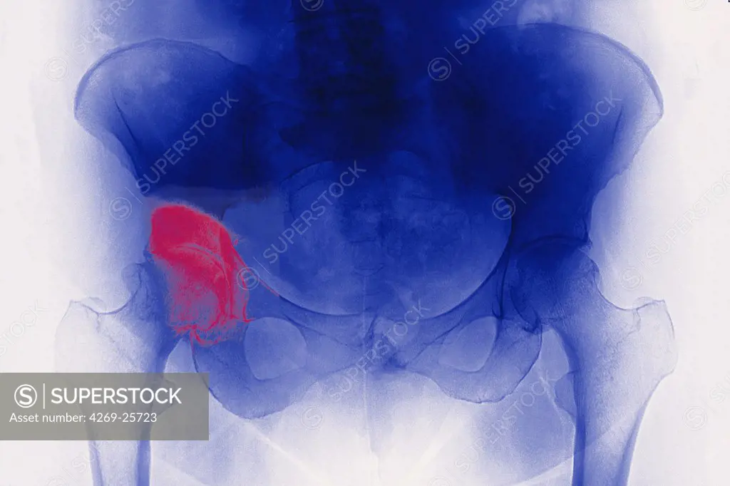 Hip osteoarthritis. X-ray showing arthritis of the hip. At lower left and right are the thigh bones., above is the pelvis. Arthritis is a joint disease that can cause cartilage destruction (seen as a reduction in the joint space, pink), bone erosions, and tendon inflammation.