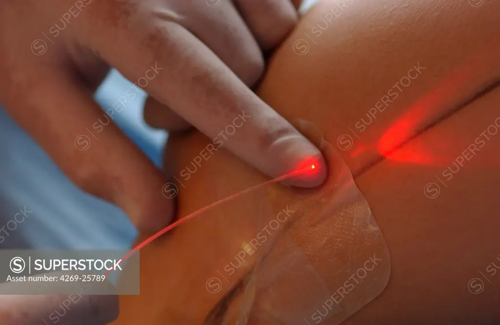 Vascular laser. The continuous wave endovenous laser is used for the treatment of varix and varicosities. An opical fiber is introduced in the veine until the area to be treated.