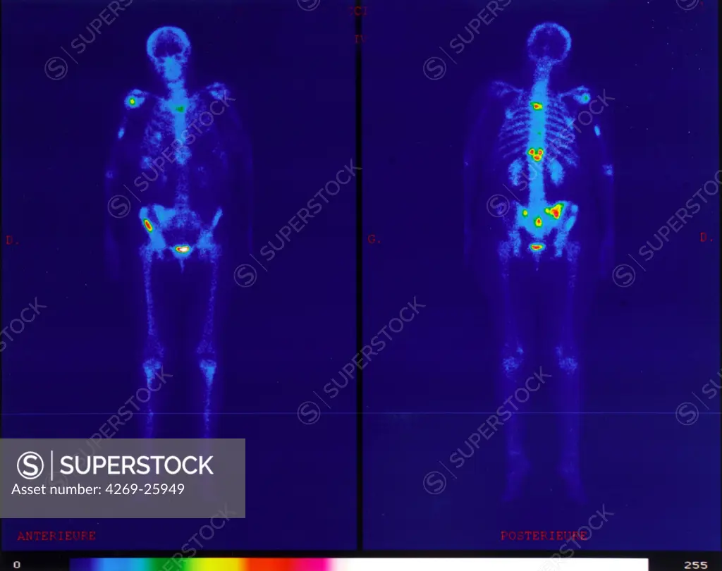 Bone scintigraphy. Gamma scans of the squeleton showing bone metastasis (in yellow) from a prostate cancer.