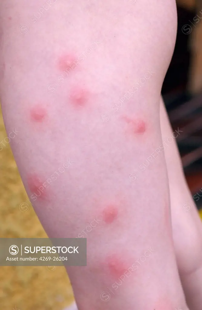 Mosquito bites. Skin allergy caused by mosquito bites.