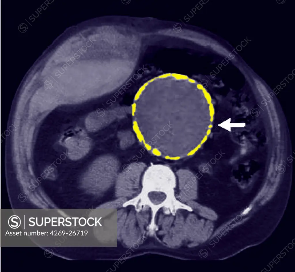 Aortic aneurysm. Axial coloured Computed Tomography (CT) scan of an abdominal aortic aneurysm. The face of the body is downwards. Spinebone is in blue. At centre is the severely enlarged, rounded artery (yellow) with its central lumen visible purple). An aneurysm is a bulge of a vessel due to the dilatation of its wall. A ruptured aneurysm can be fatal.