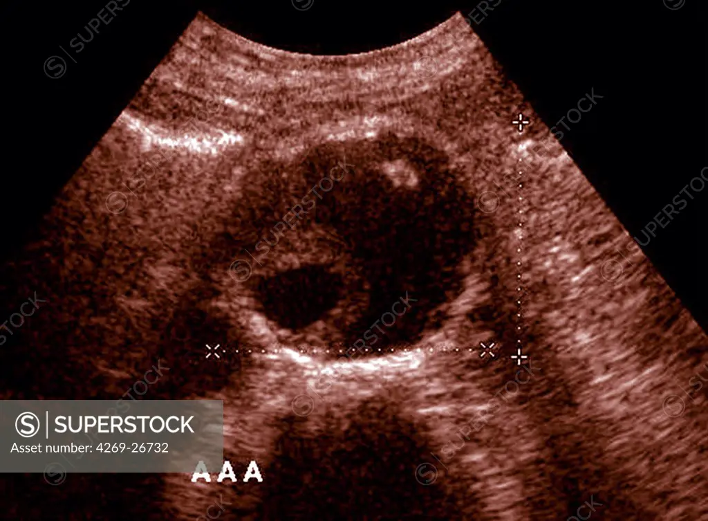 Aortic aneurysm. Ultrasound scan of the abdominal aortic artery showing an aneurysm. At centre is the swollen area of the artery (dark). White index marks on the screen measure the aneurysm diameter. An aneurysm is a bulge of a vessel due to the dilatation of its wall. A ruptured aneurysm can be fatal.