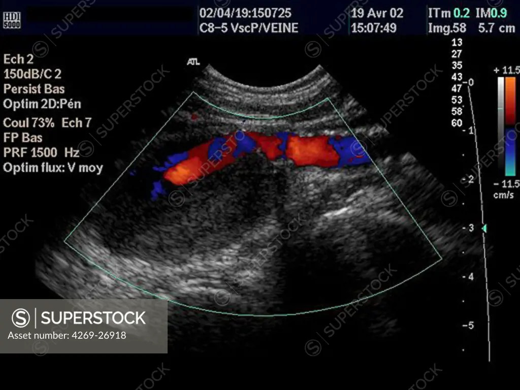 Aneurysm of the popliteal artery. Color Doppler ultrasound scan of an aneurysm of the popliteal artery. Doppler ultrasound or echodoppler scanning detects moving fluids. Color is used to illustrate moving fluid, not flow direction.