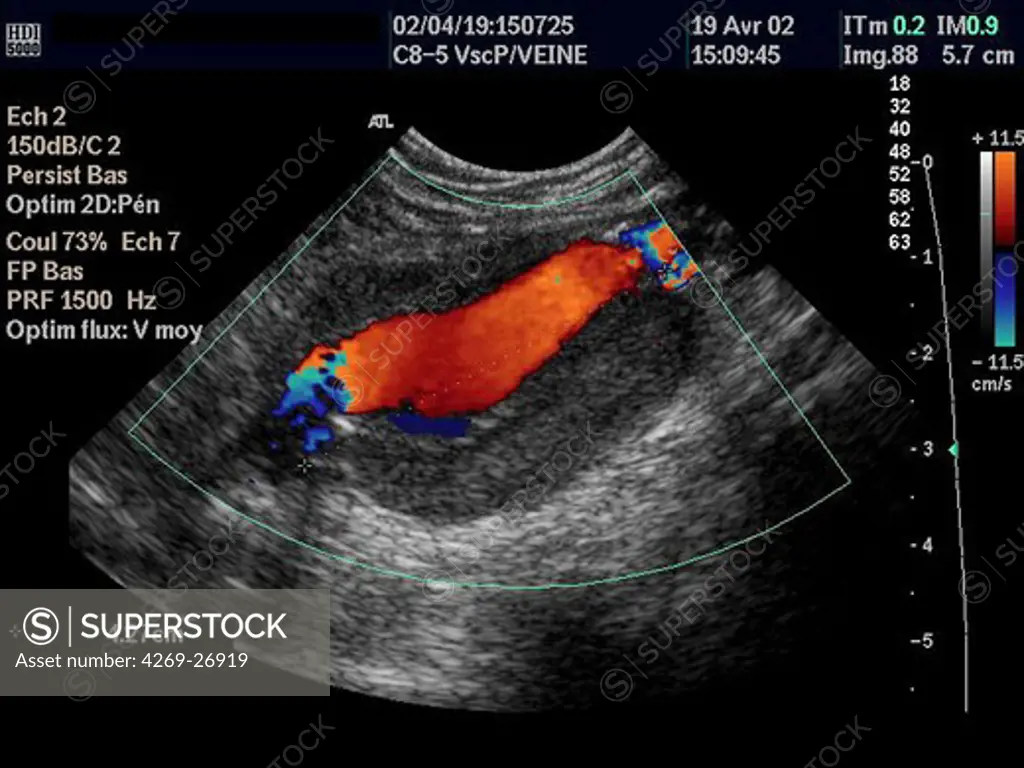 Aneurysm of the abdominal aorta. Color Doppler ultrasound scan of an aneurysm of the abdominal aorta showing circulating lumen of the artery (orange), the rest of the bulge is occupied by a thrombus (clot)  seen in dark grey. Doppler ultrasound or echodoppler scanning detects moving fluids. Color is used to illustrate moving fluid, not flow direction.