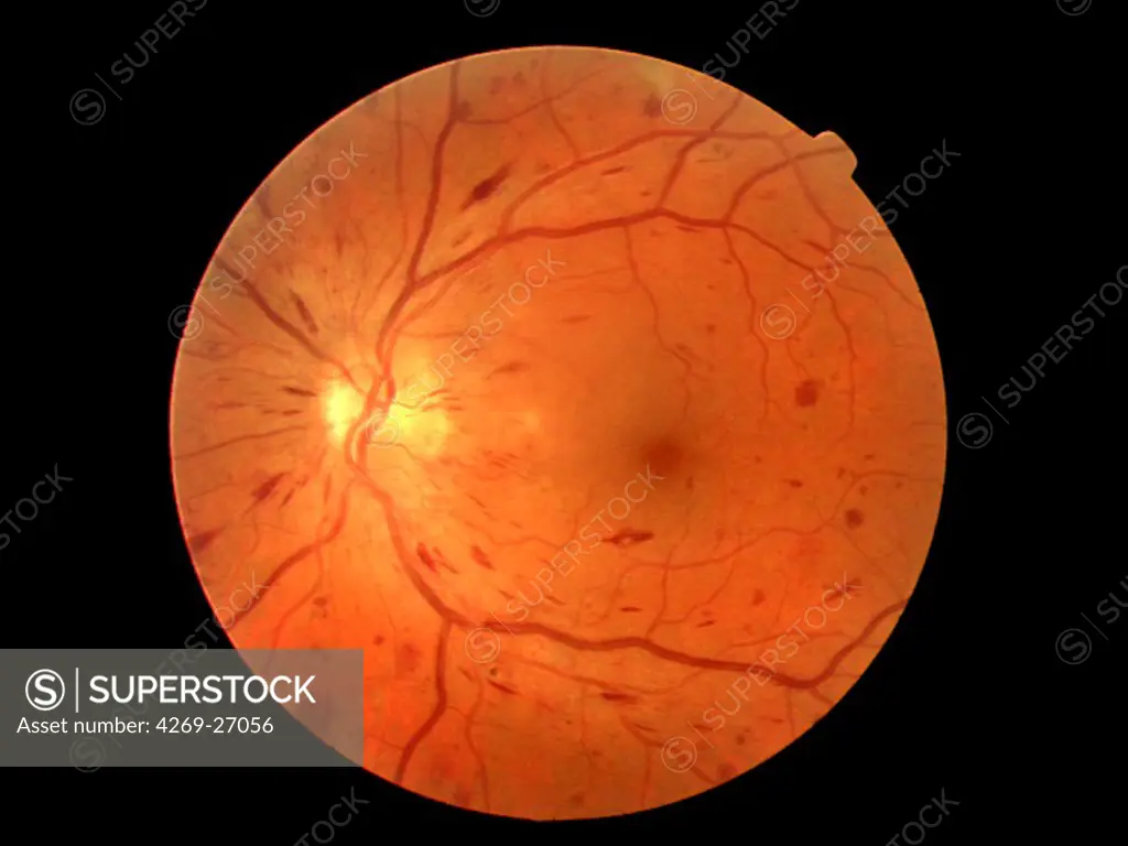 Diabetic retinopathy. Fundus camera image (ophthalmoscope) of the retina showing acute non-proliferative diabetic retinopathy.
