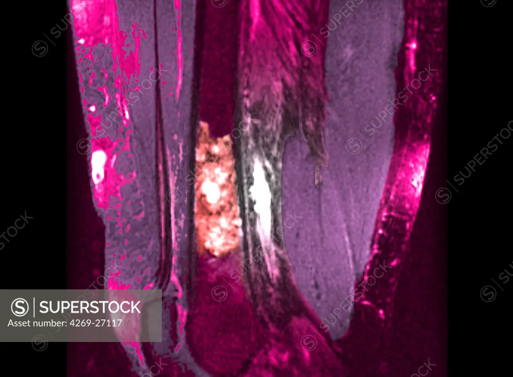 Chondroma. Color enhanced Ct scan of the leg showing a chondroma of the femur (thigh bone). This benign bone tumor is formed by a calcified cartilage matrix giving the bone marrow its spotted aspect (in pink).