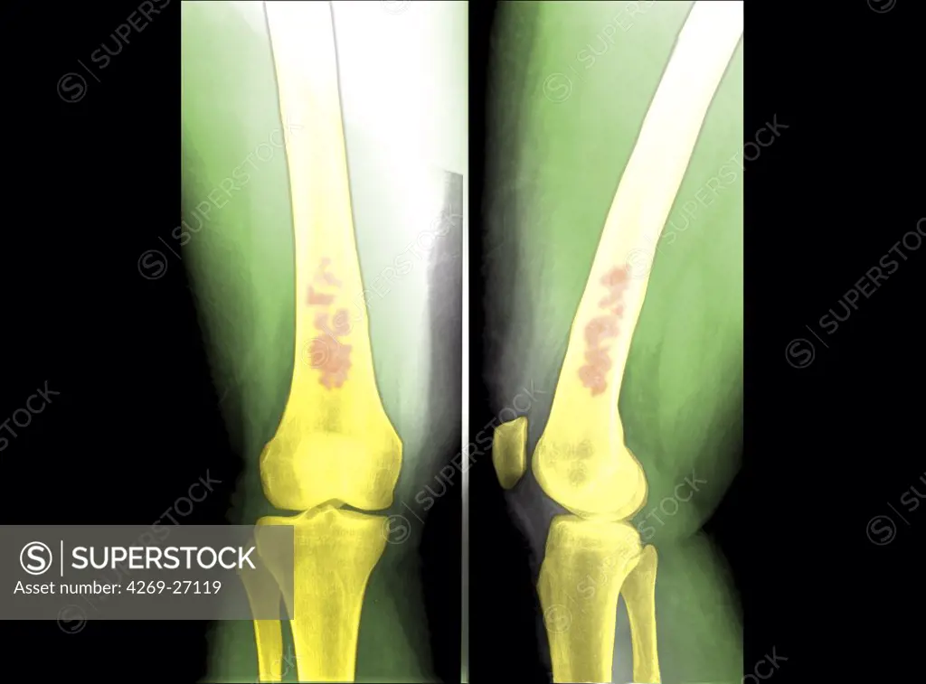 Chondroma. Colored X-ray of the leg showing a chondroma of the femur (thigh bone). This benign bone tumor is formed by a calcified cartilage matrix giving the bone marrow its spotted aspect (in brown).