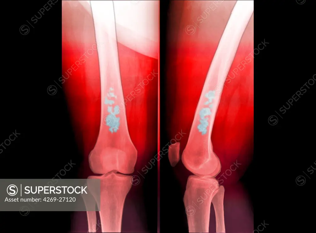 Chondroma. Colored X-ray of the leg showing a chondroma of the femur (thigh bone). This benign bone tumor is formed by a calcified cartilage matrix giving the bone marrow its spotted aspect (in blue).